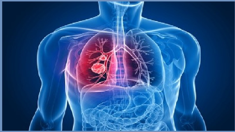 Illustration for article titled Long-Term Effects of Air Pollution